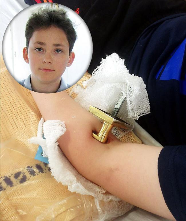 Accident cumplit. Ce i-a ramas infipt in corp, la cativa milimetri de o artera, unui baiat de 12 ani care se juca in casa