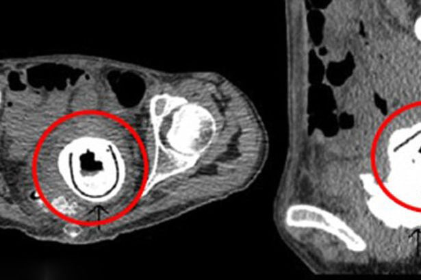 O femeie din Scotia a trait timp de 10 ani cu o jucarie sexuala in organism. Medicii au descoperit-o in timpul unei operatii