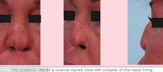 O femeie a apelat la operatie pentru a-si repara nasul distrus de cocaina. Motivul pentru care a dat medicul in judecata