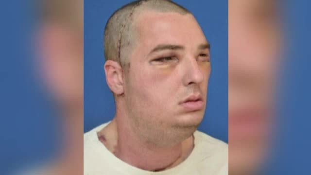 Timp de 15 ani a trait ca Fantoma de la Opera, ascunzandu-si chipul desfigurat. 150 de medici s-au chinuit sa-i refaca fața