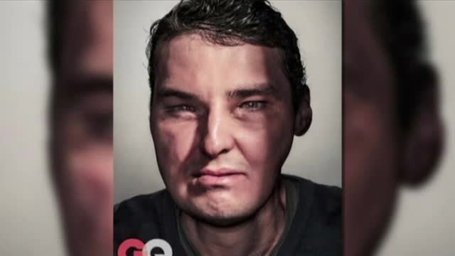 Timp de 15 ani a trait ca Fantoma de la Opera, ascunzandu-si chipul desfigurat. 150 de medici s-au chinuit sa-i refaca fața
