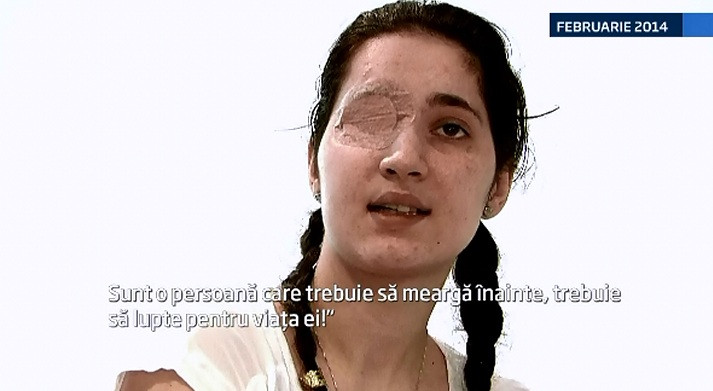 Daniela, tanara impuscata anul trecut in ochiul drept, a trecut printr-o noua interventie. Ce spun medicii despre proteza
