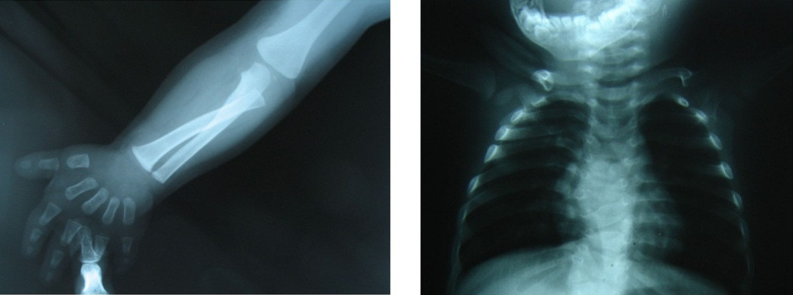 Mama si fiul impart aceeasi boala cumplita. S-au nascut fara brate, insa determinarea lor a devenit sursa de inspiratie