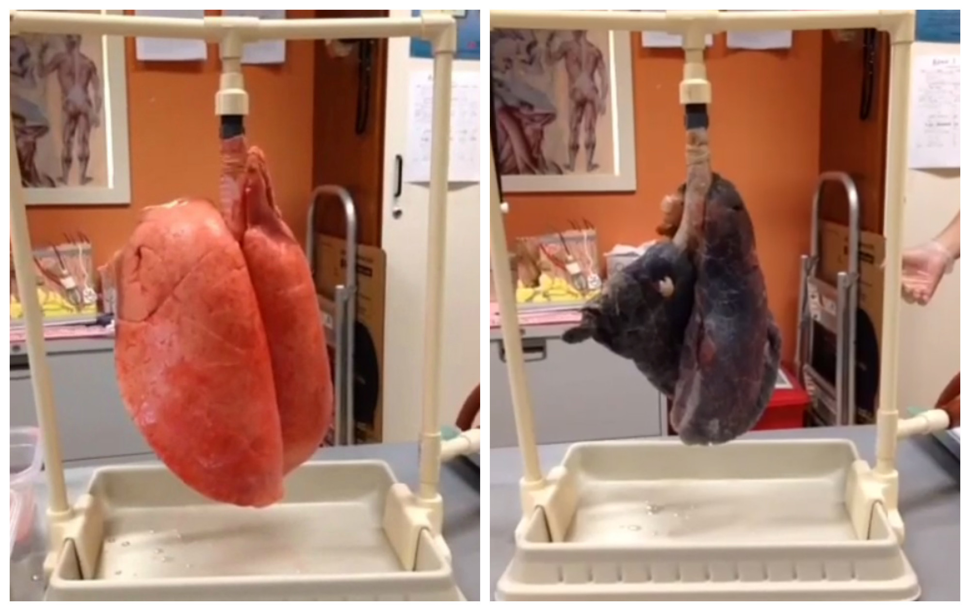 In doar cateva secunde, aceasta inregistrare te va face sa te lasi de tigari. Cum arata de fapt plamanii unui fumator