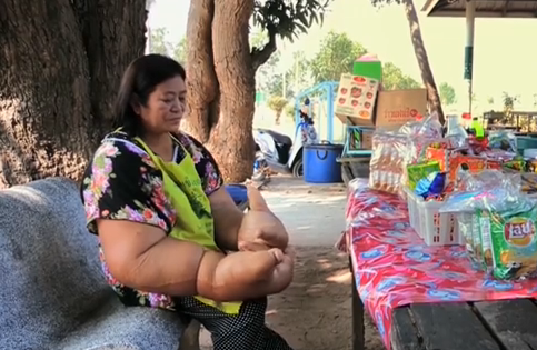 Are cele mai mari brate din lume din cauza unei boli de care doar ea sufera. Solutia medicilor, de neacceptat pentru femeie