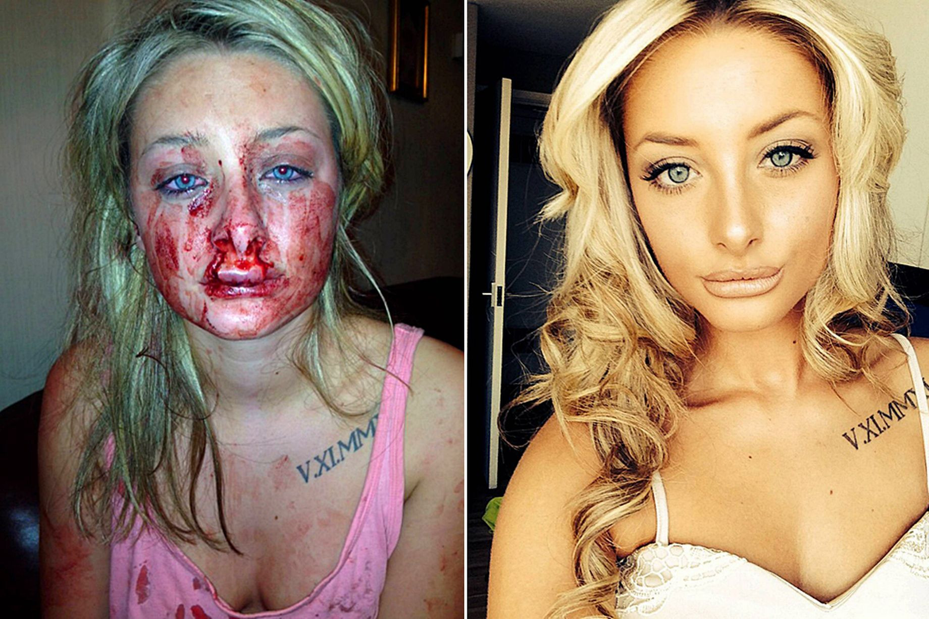 A castigat un concurs de frumusete la un an dupa ce a fost desfigurata de iubitul gelos. Ce s-a intamplat cu barbatul