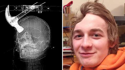 Urmarile dramatice ale unui atac violent. Cum arata chipul unui tanar dupa ce a fost lovit in cap cu un ciocan