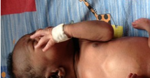 Un bebelus nascut cu patru maini si patru picioare, operat cu succes pentru a i se inlatura "geamanul parazit"