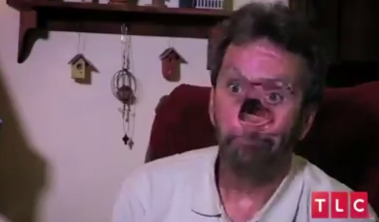 A reusit sa isi sarute din nou sotia dupa 10 ani. Cum arata barbatul cu chipul mutilat de cancer dupa reconstructia faciala