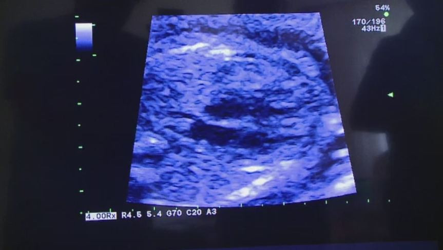 Un expert in ginecologie care raspunde direct Ministrului Sanatatii ancheteaza cazul fetitei din Iasi moarta la nastere