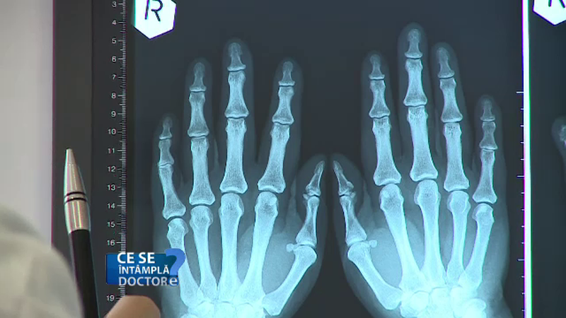 Artrita reumatoida, boala "mascata" de simptomele asteniei. Femeile sunt de doua ori mai afectate decat barbatii