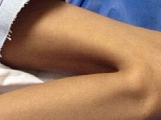 Piciorul unei adolescente a putrezit dupa o muscatura de sarpe. Imagini cu impact emotional puternic