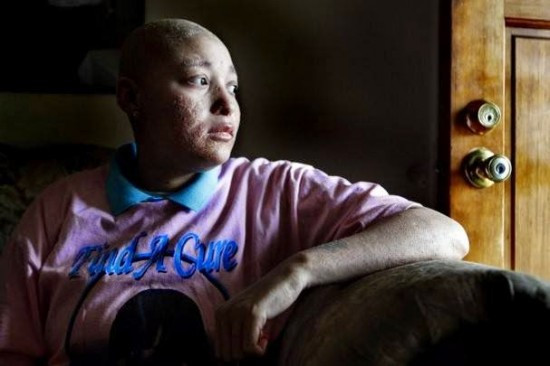 Caz ciudat in SUA. Medicii nu au aflat ce se intampla cu singura persoana din lume care sufera de aceasta boala