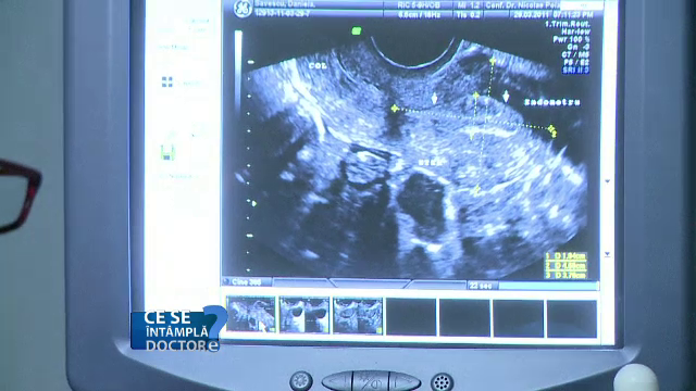 Endometrioza, a doua cauza de infertilitate la varsta tanara. Masurile preventive recomandate de medici