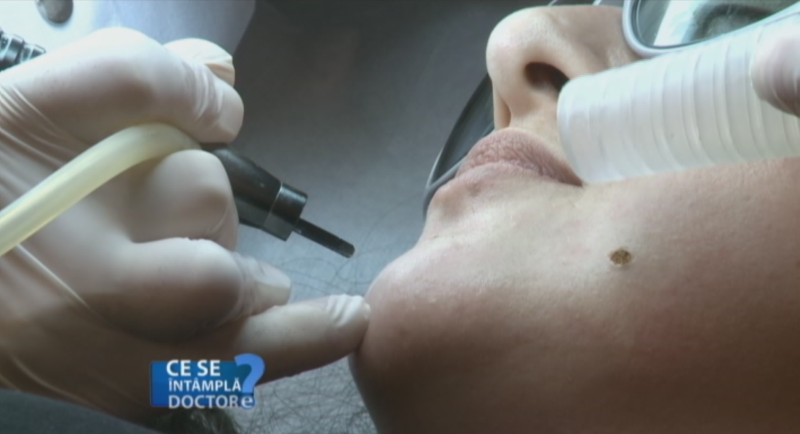 Sfatul specialistilor: Cum poti urmari singur evolutia alunitelor sau cicatricelor si cand trebuie sa apelezi la medic