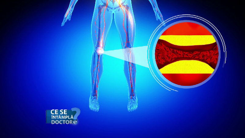 Bolile cardiovasculare, strans legate de alimentatie. Grasimile recomandate de medici pentru protejarea vaselor sanguine