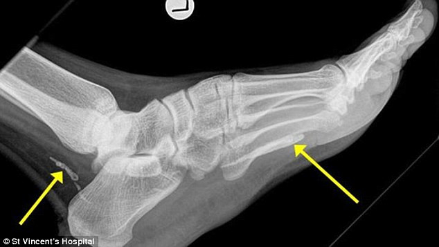 A mers la medic din cauza unei dureri la picior. A descoperit ca traia cu el in organism de 4 ani fara sa fi banuit ceva