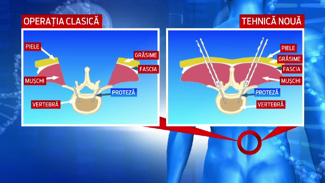 Operatia care costa de 20 de ori mai putin in Romania decat in Statele Unite. Procedura presupune doua implanturi in vertebre