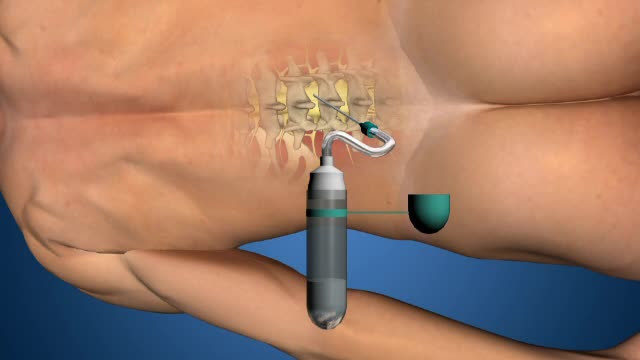Ce sunt punctiile lombare pe care un neurochirug le-ar fi facut fara acordul pacientilor. Ancheta fara precedent la Iasi