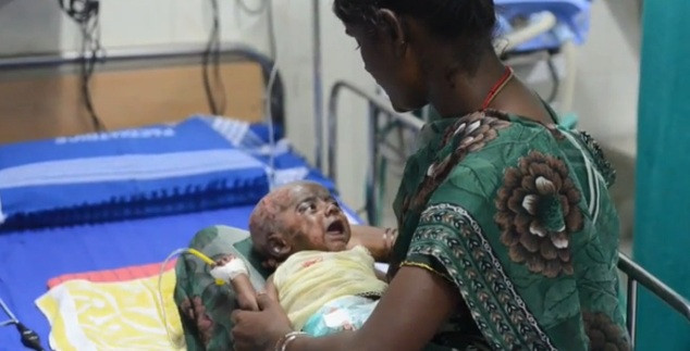 Povestea fratilor din India care au luat foc de cinci ori pana acum. Mama lor spune ca micutii sufera de "combustii spontane"