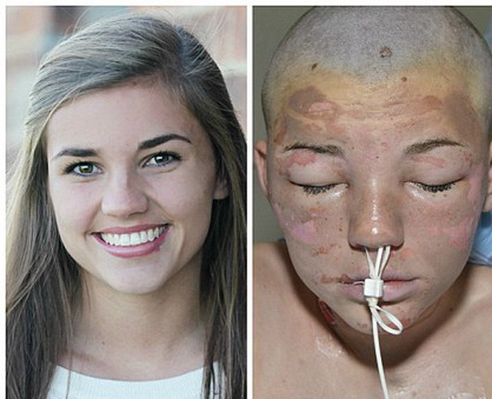 Adolescenta desfigurata dupa explozia care i-a spulberat casa. La doua luni dupa incident este de nerecunoscut. FOTO