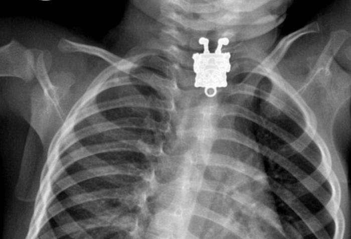 Radiografia zambitoare realizata in corpul unui copil. Ce inghitise micutul