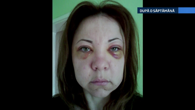 Cum a ajuns sa arate o avocata din Alba Iulia, dupa ce medicul estetician i-ar fi injectat venin de vipera in loc de botox