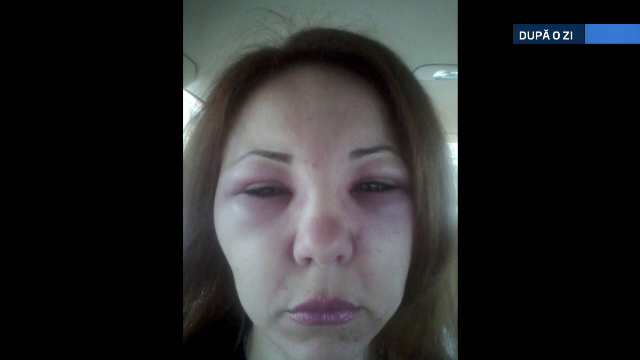 botox