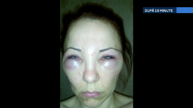 botox