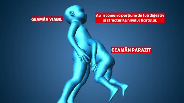 ANIMATIE GRAFICA: Operatie dificila de separare a unor siamezi la spitalul Marie Curie. Doar unul dintre frati a supravietuit