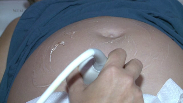 O batrana de 92 de ani din Chile a purtat in corp, timp de 70 de ani, un fetus impietrit. Cum a fost posibil