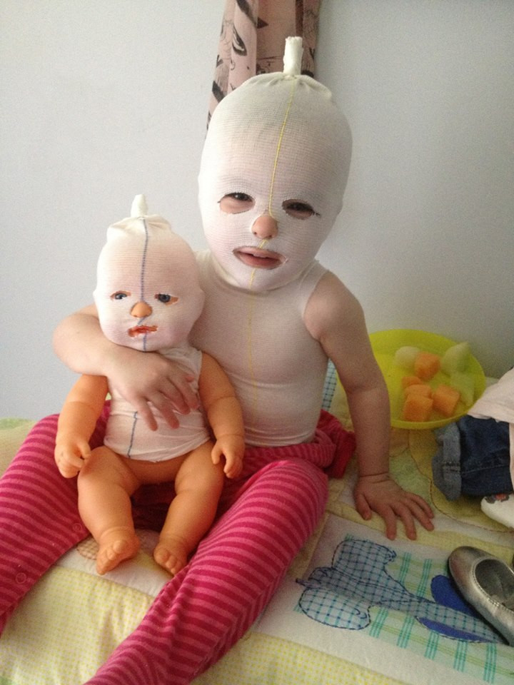 Fetita care "ia foc" daca sta la soare. Boala extrem de rara care o obliga sa stea bandajata din cap pana in picioare mereu