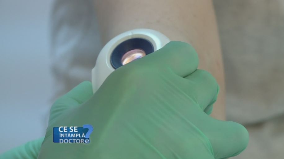 Cel mai agresiv tip de cancer poate fi evitat cu un simplu control dermatologic. Ce trebuie sa stim despre melanom