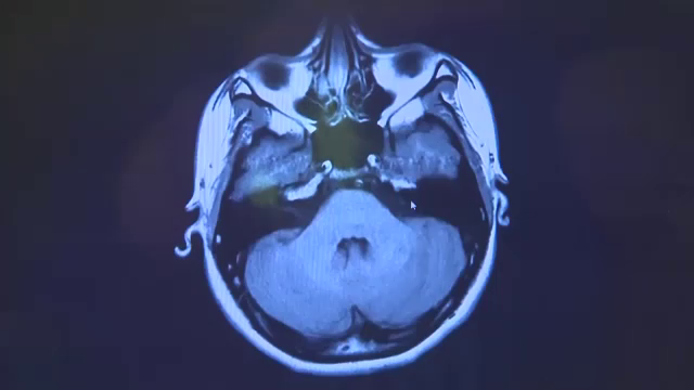 Stergerea amintirilor neplacute ar putea deveni realitate. Cercetatorii din SUA au reusit in premiera un astfel de experiment