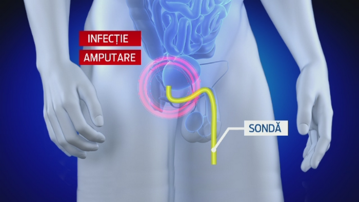 Un barbat din Buzau spune ca i-a fost amputat penisul din cauza neglijentei medicilor. Cere daune de 500.000 de euro