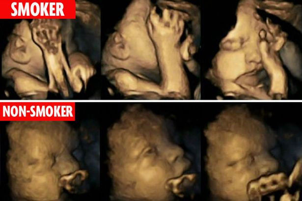 Imaginile dramatice care arata cum se comporta in pantece bebelusii mamelor fumatoare. Ce au stabili medicii