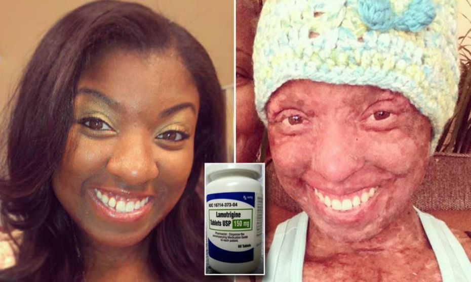 Drama pentru o tanara din SUA. A ramas fara 90% din piele dupa o reactie adversa la un medicament