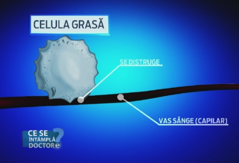 Obezitatea nu este o problema estetica. Modificarile nocive care au loc in organism dupa acumularea kilogramelor