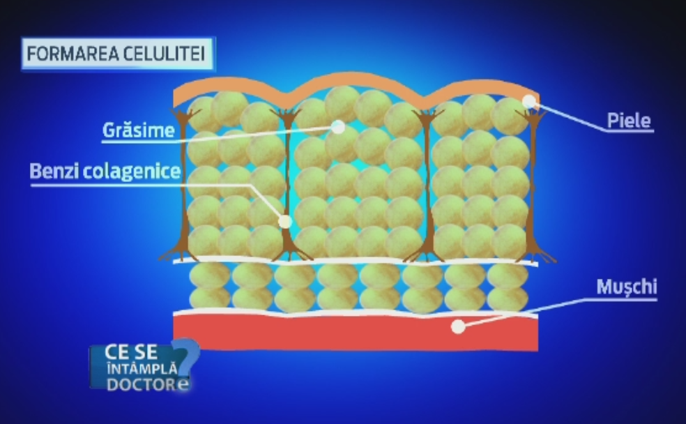 Celulita, boala tesutului adipos de care toate femeile incearca sa scape. Medicii spun care este abordarea corecta