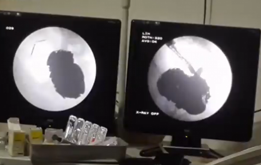 Un barbat a inghitit sute de monede, cuie si alte metale pentru ca era depresiv. Medicii au fost socati cand l-au examinat