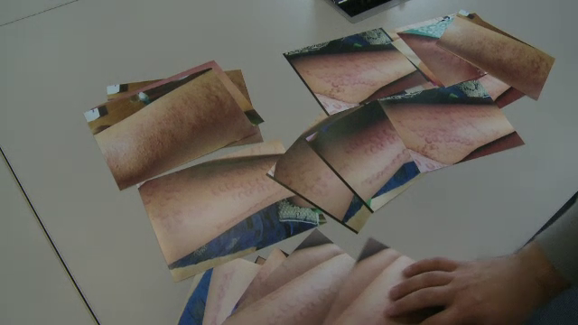 O tanara sustine ca s-a ales cu arsuri permanente in urma unei interventii cu laser. Ce spun reprezentantii spitalului