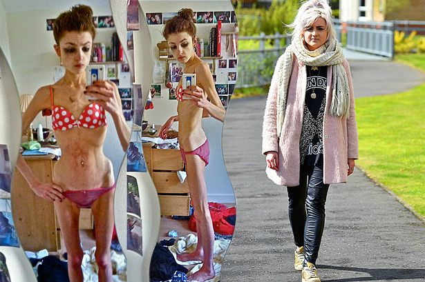 A ajuns sa fie anorexica dupa o noapte petrecuta cu un baiat. Drama unei tinere care a ajuns la 25 de kg cu 13 calorii pe zi