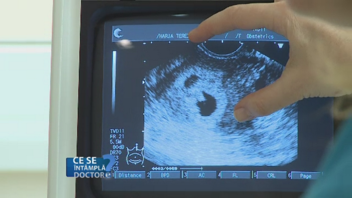 Cand trebuie sa va ingrijorati in privinta chisturilor ovariene. Specialistii spun ca un control anual este esential