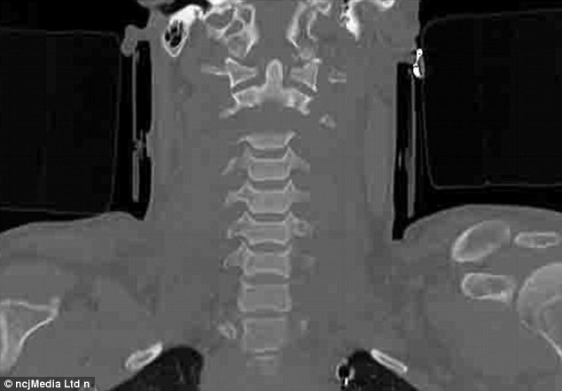 Capul i s-a desprins de sira spinarii in momentul accidentului. Povestea barbatului care i-a surprins pe medici