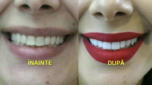 Costul urias al unei danturi perfecte. Cine sunt romanii care platesc peste 5.000 de euro pentru a zambi ca un californian