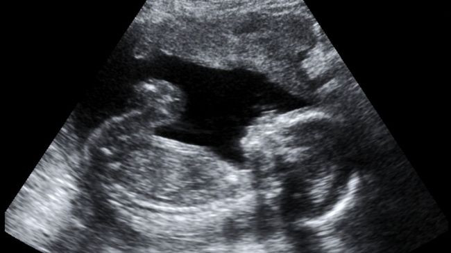 Boala foarte rara cu care s-a nascut acest baietel il face sa semene cu Pinocchio. Cum s-a schimbat dupa mai multe operatii