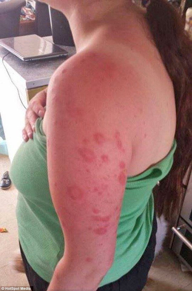 “Este un vampir”. Cum arata femeia din Marea Britanie care nu are voie sa iasa afara pe timp de zi