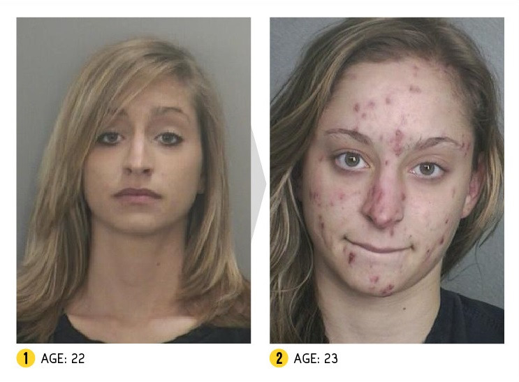 Efectele drogurilor asupra chipului uman. Imaginile dinainte si dupa sunt cutremuratoare. FOTO