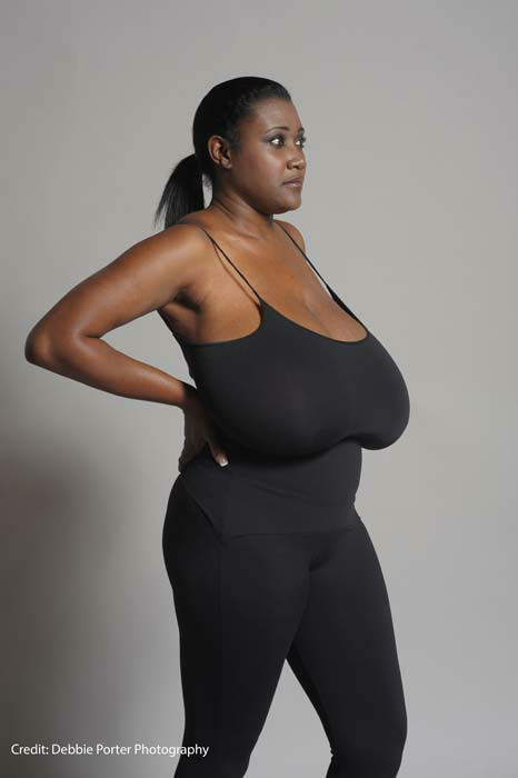 La 40 de ani, sanii ei nu se opreau din crescut. Cum arata aceasta femeie dupa ce trecut printr-o reductie mamara record