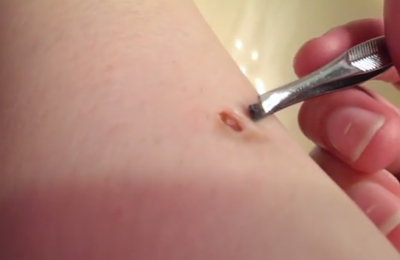 Imagini incredibile. Momentul in care o femeie isi scoate din picior un parazit, cu o penseta, in propria baie. VIDEO